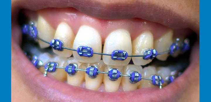 damon-braces-cheap-braces-dublin