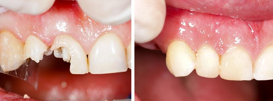 Restorative Treatments - Fillings